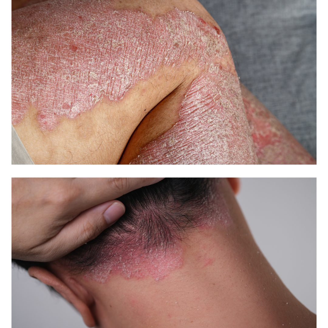Inflamed, scaly psoriasis plaques with silvery-white scales
